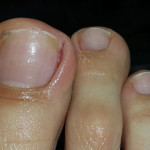 Wrastający paznokieć